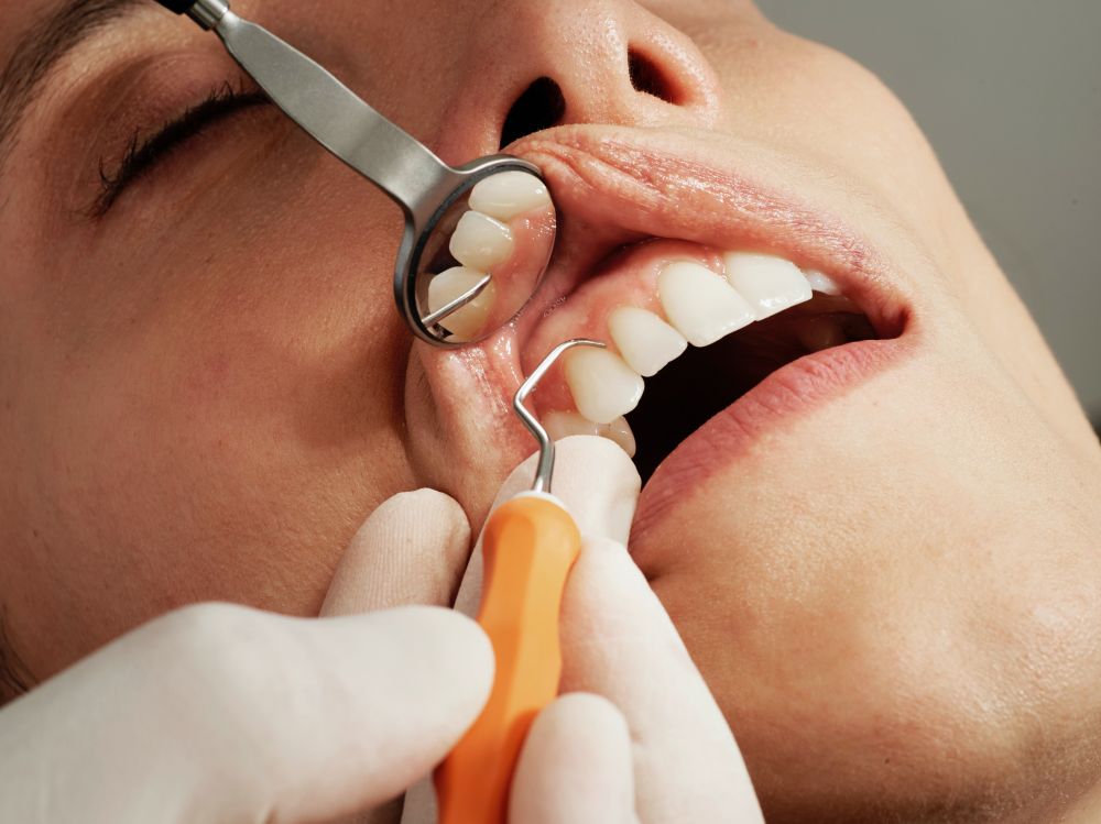 Få lappet huller i tænderne hos din tandlæge i Næstved